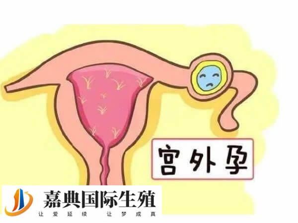 宫外孕早期的征兆有哪些(图2)